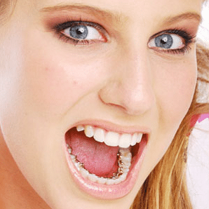 Woman with Incognito Braces on her teeth