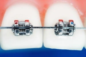 Metal braces on front teeth
