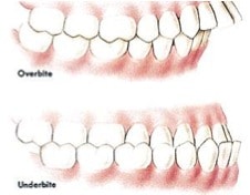 Drawing of an overbite and underbite