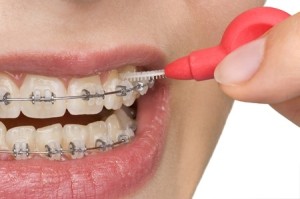 Brace wearer using an interdental brush