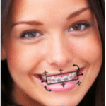 BraceFace App