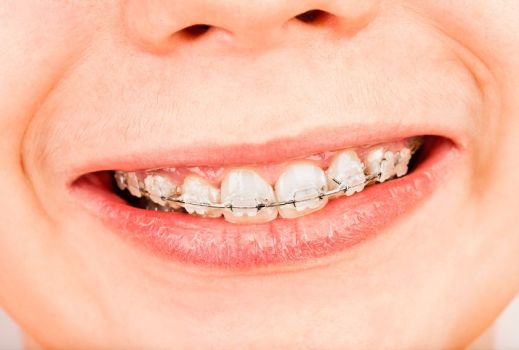 Young boy in braces in two phase orthodontic treatment