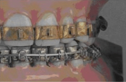 Photo of banded braces used in the 1920s