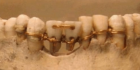 Gold wire used as ligatures in ancient jaw