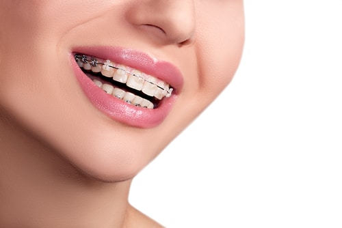 Woman smiling in orthondontic braces
