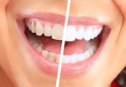 Before and after shot of teeth whitening