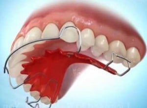 Rendering of Hawley Retainer on teeth