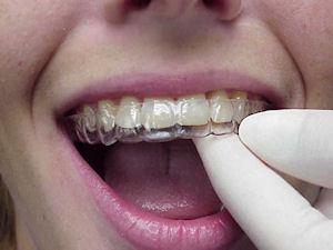 Essix retainer on teeth