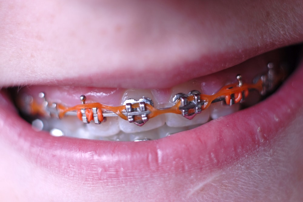 braces with orange chain of elastics