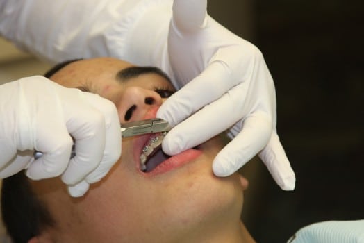 Dental braces being removed