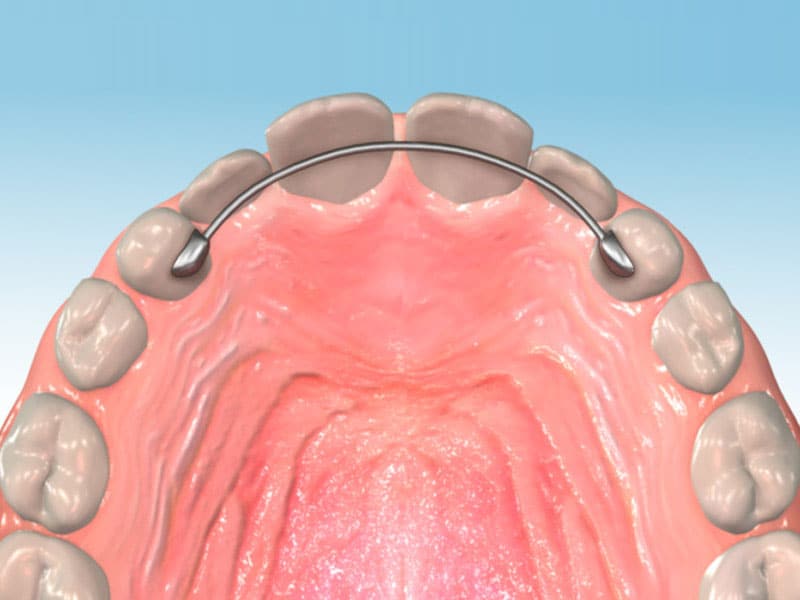 Types Of Retainers For Teeth After Braces at Ana Peterson blog