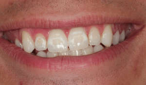 White spots on teeth after braces