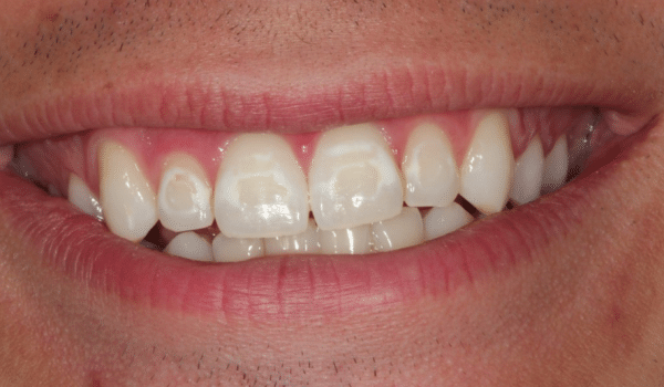 how-do-you-treat-white-spots-after-braces-ask-an-orthodontist