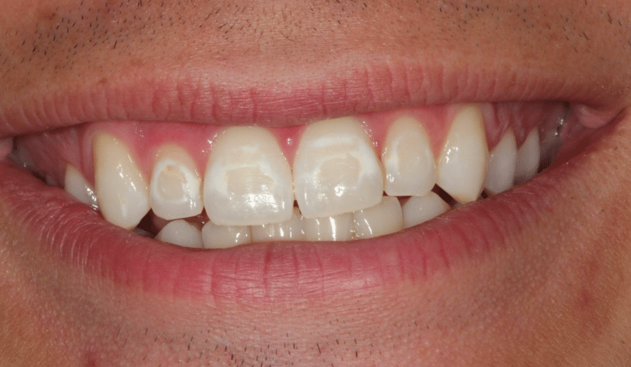 Braces And White Spots On My Teeth Orthodontic Associ - vrogue.co