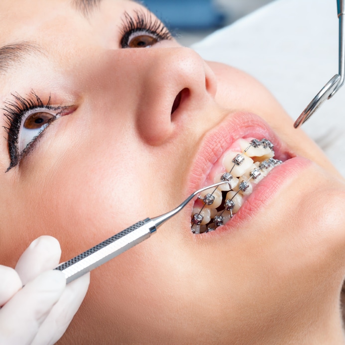 Extreme close up of hands working on orthodontic braces