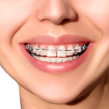 Ceramic braces on top teeth with metal braces on bottom teeth