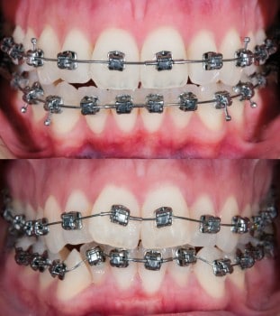 How Can Orthodontic Treatment Change Your Life?