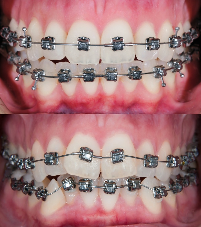 Before and after photos of teeth with braces