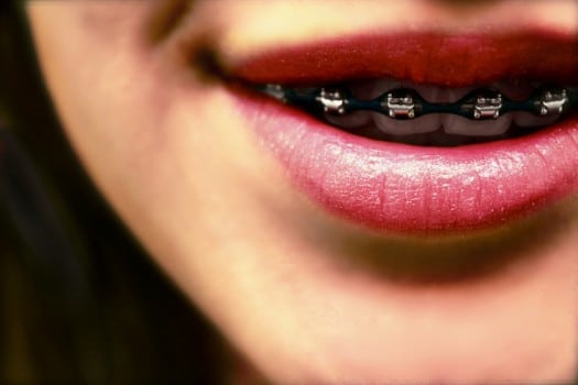 Close up of smiling mouth and teeth with Braces
