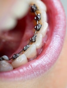 Lingual Braces on the backs of teeth