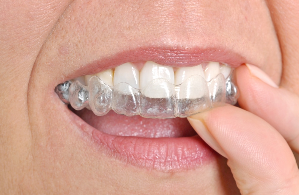 Clear Aligners - Easy, Affordable Alternative to Traditional Braces