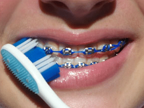 Brushing with braces on