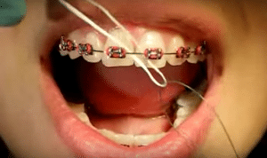 Flossing technique using braces
