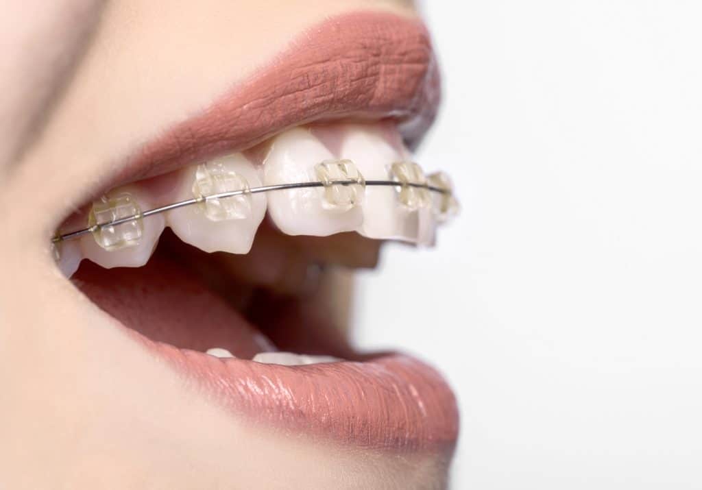 What Is “Accelerated Orthodontics,” And How Does It Work? Orthodontic