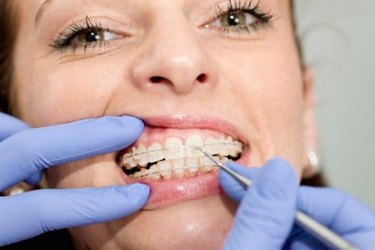 Woman having Braces adjusted by orthodontist