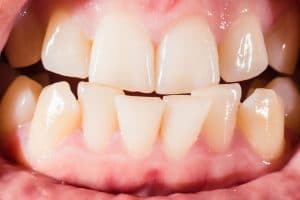 close up of a malocclusion and bad bite