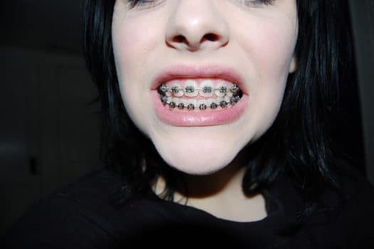 girl with braces on teeth