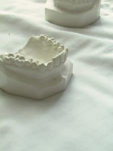Orthodontist's mould of top teeth