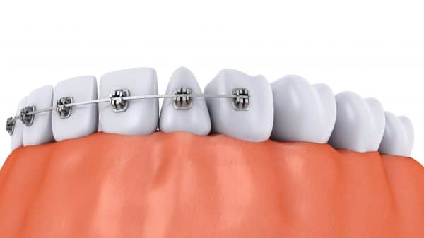 Should I Get a Dental Implant before Or After Braces?  