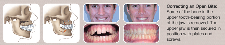 Jaw surgery on the top jaw before and after photos