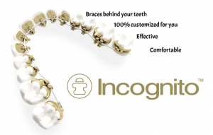 Incognito Braces