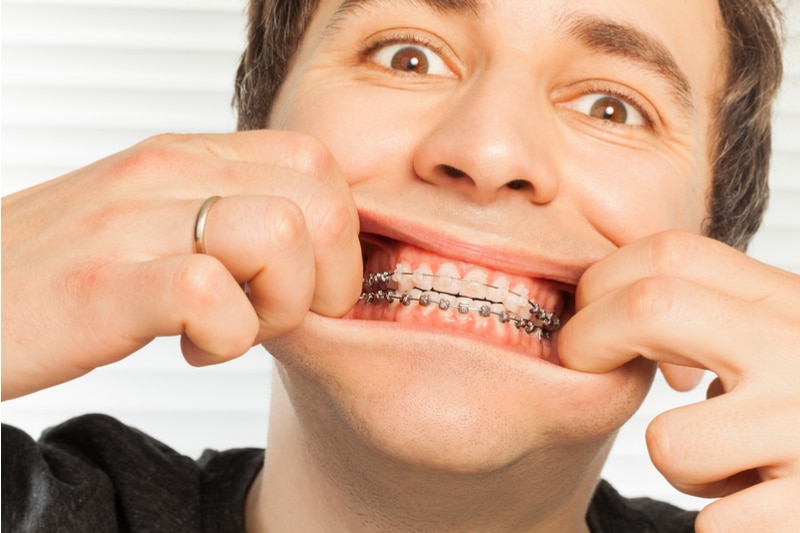 Man pulling lips apart to show traditional braces