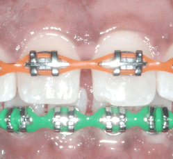 Power chains on top and bottom braces