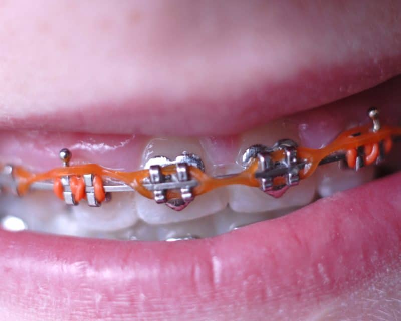 braces without elastics