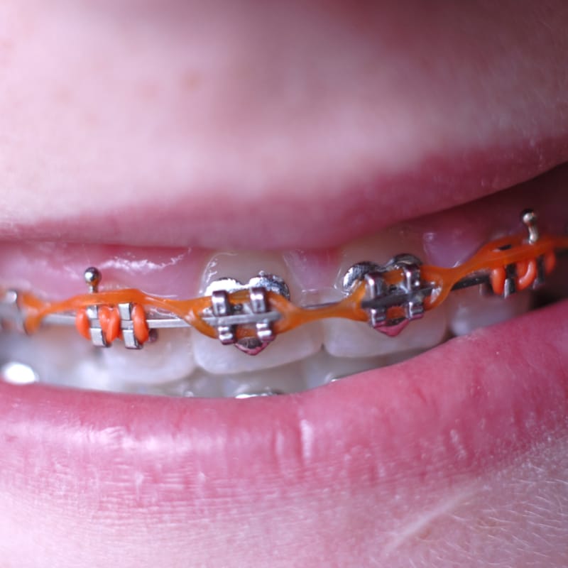 Close up of braces and power chains