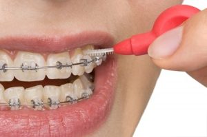 Nahaufnahme der Reinigung der Interdentalbürste zwischen den Zahnspangen