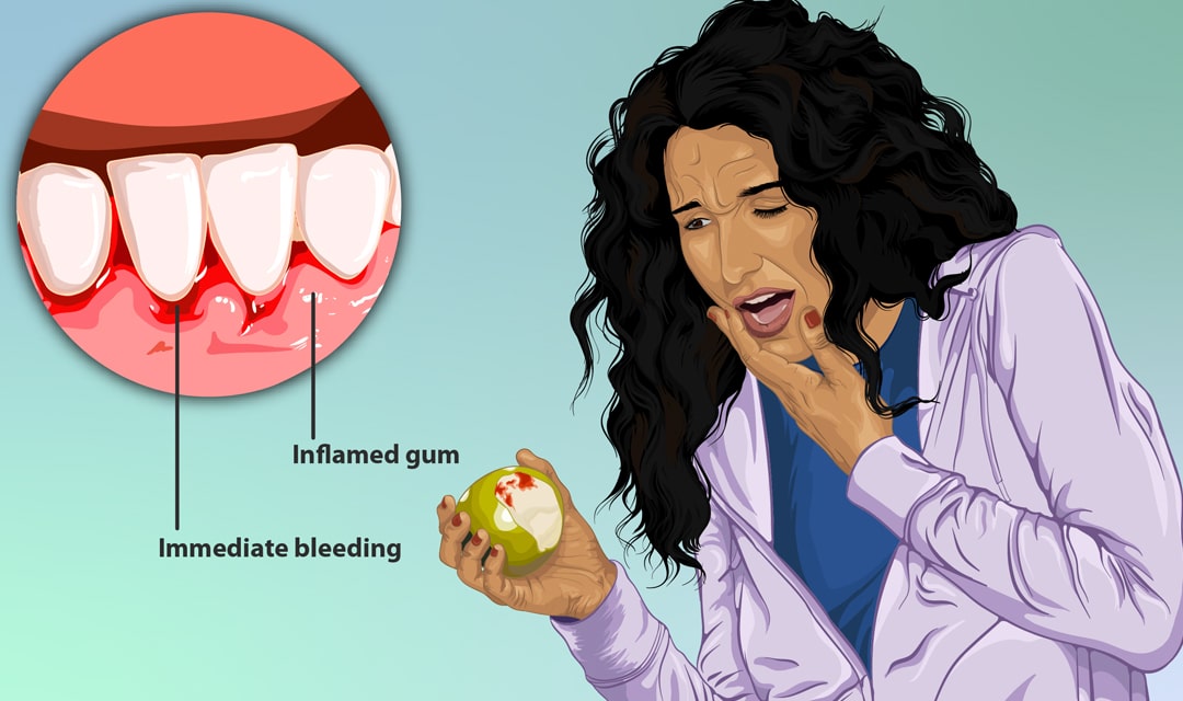 Understanding Gum Disease
