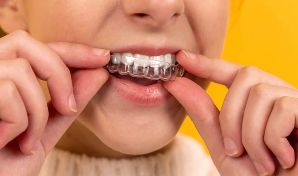 What to Do if Your Retainer Doesn’t Fit Anymore Orthodontic Associates