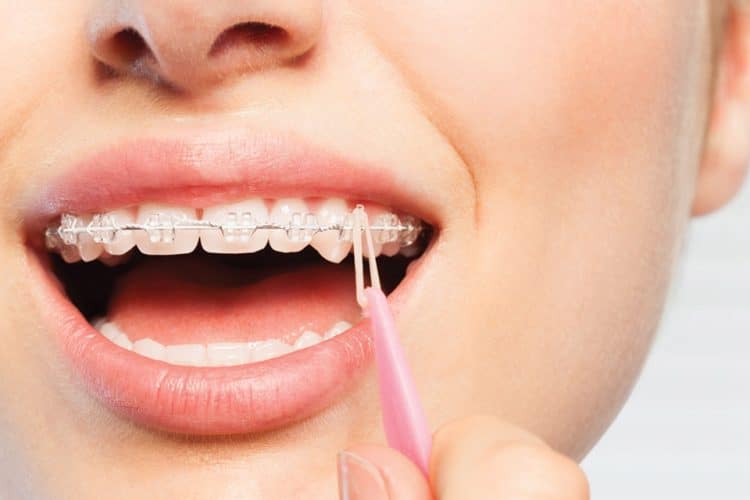 Close up of a person's smile with braces putting elastics on with a hook