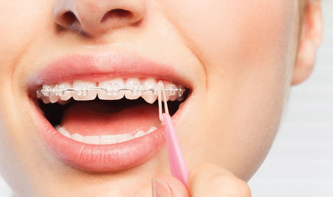 Close up of a person's smile with braces putting elastics on with a hook